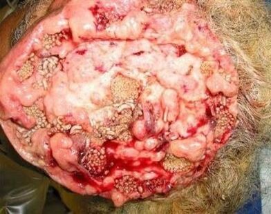 parasieten in het menselijk brein