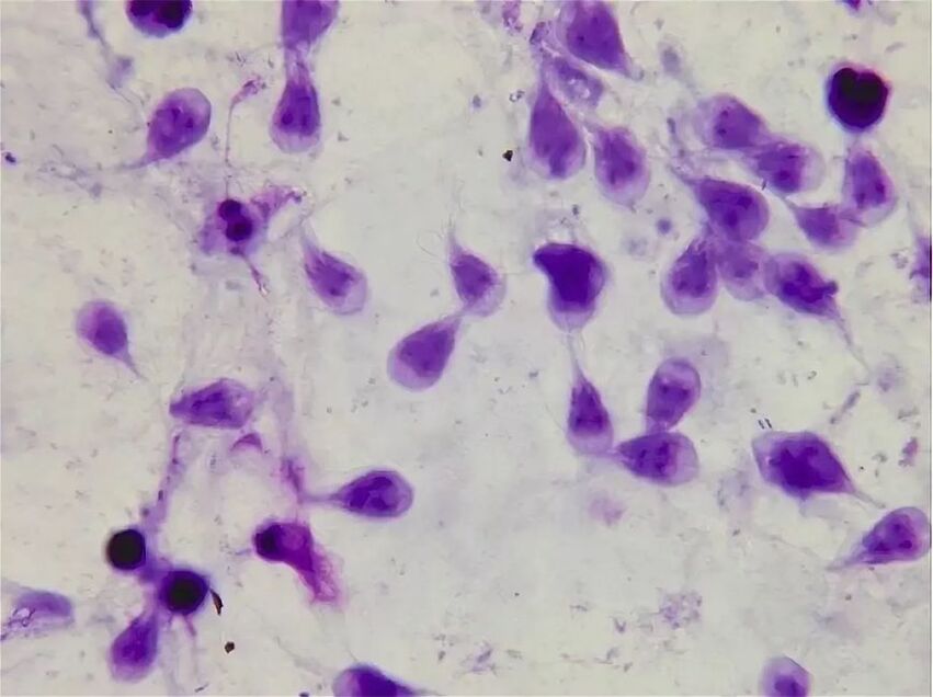 hoe zich te ontdoen van menselijke lamblia